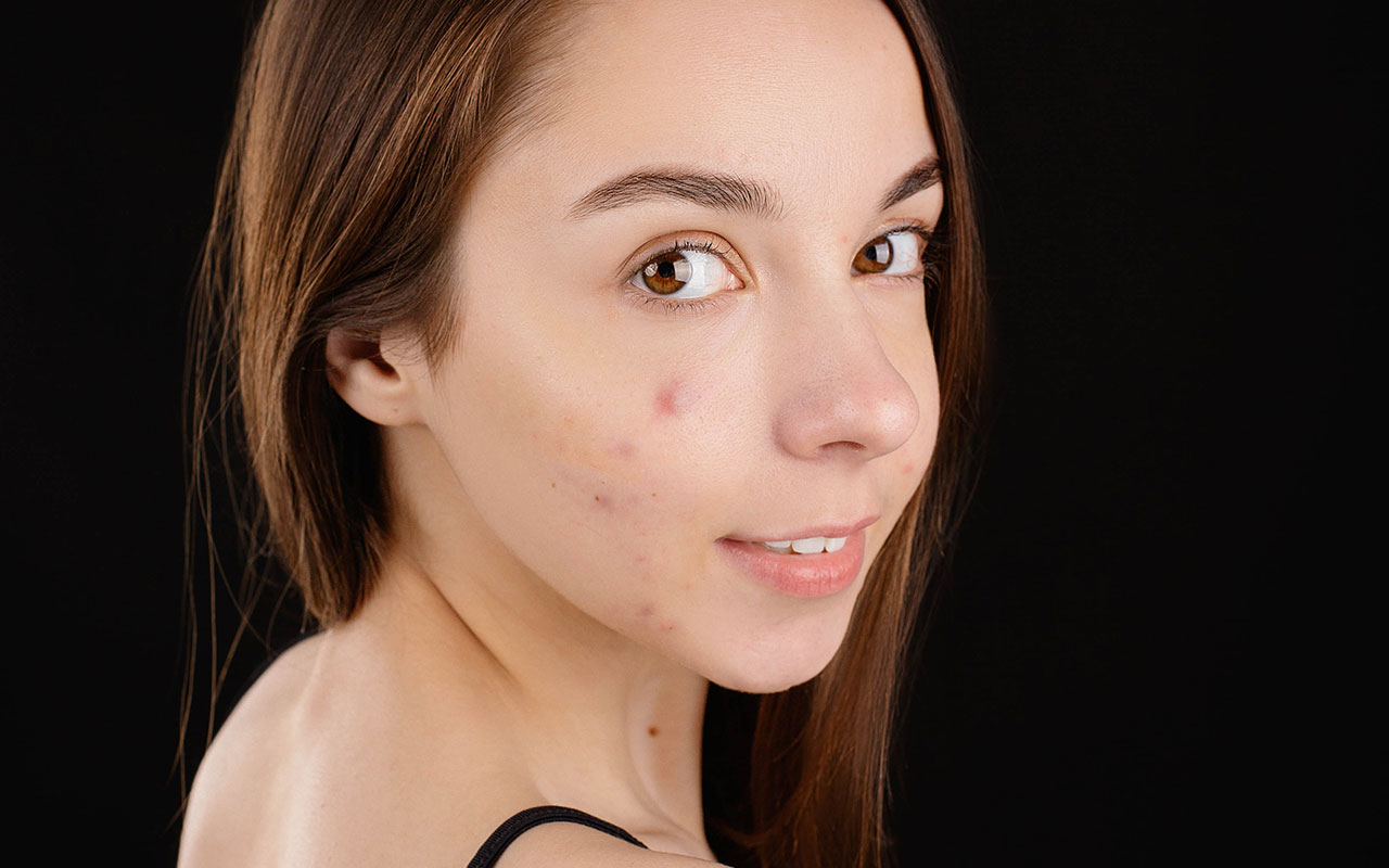 girl-with-acne