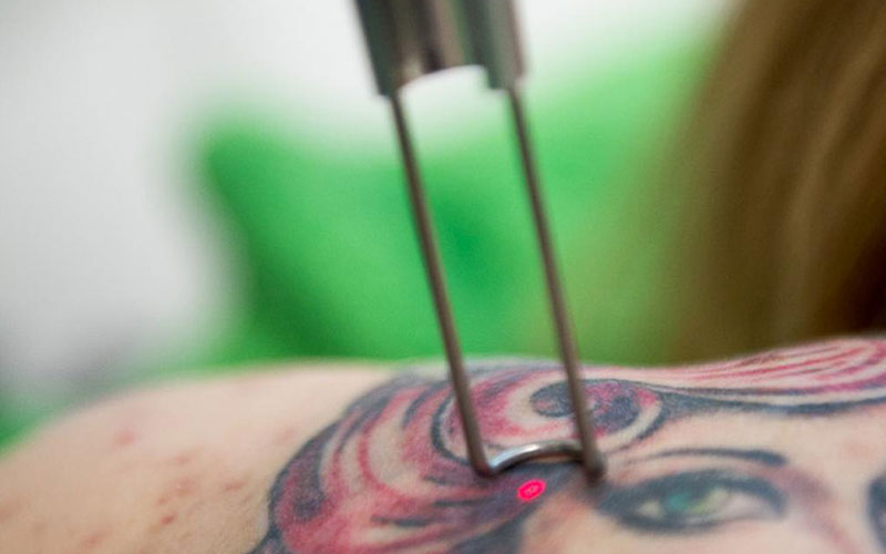 Like being burned with cooking oil': how tattoo removal became a booming  business | Tattoos | The Guardian